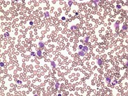 Juvenile myelomonocytic leukemia - 1.