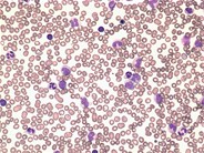Juvenile myelomonocytic leukemia - 1.