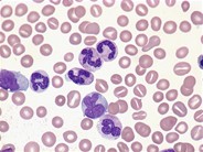 Juvenile myelomonocytic leukemia - 2.