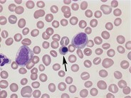 Juvenile myelomonocytic leukemia - 4.