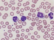 Juvenile myelomonocytic leukemia - 5.