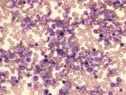Juvenile myelomonocytic leukemia - 6.