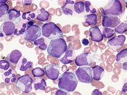 Juvenile myelomonocytic leukemia - 7.