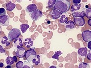 Juvenile myelomonocytic leukemia - 8.