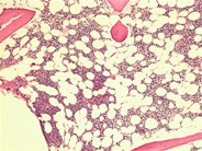 Relapsed precursor B-ALL–bone marrow biopsy - 1.