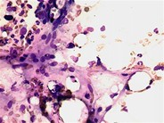 GVHD–bone marrow aspirate - 2.