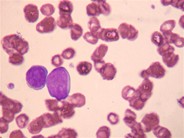 Small-cell neuroendocrine carcinoma with bone marrow and peripheral blood involvement mimicking a lymphoma in leukemic phase - 1.