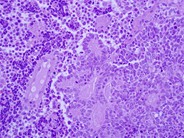 Small-cell neuroendocrine carcinoma with bone marrow and peripheral blood involvement mimicking a lymphoma in leukemic phase - 5.