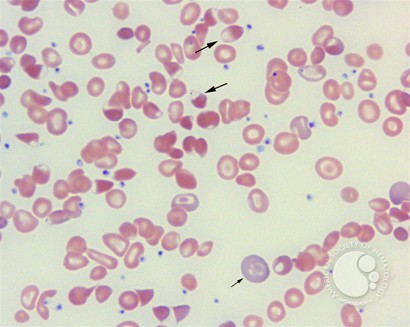 Blister cell - 1.