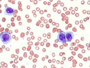 Hemophagocytic lymphohistiocytosis associated with AML-M5a - 1.