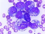 Acute myeloid leukemia with histiocytic differentiation - 1.