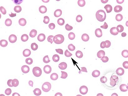 Schistocyte - 1.