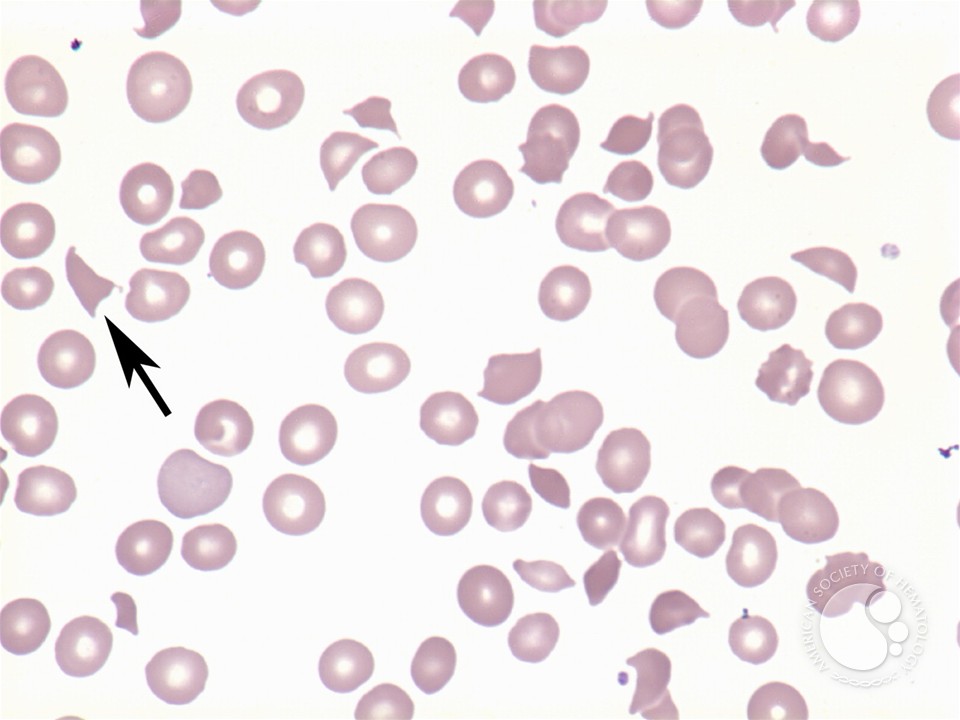 Microangiopathic hemolytic anemia - 1.