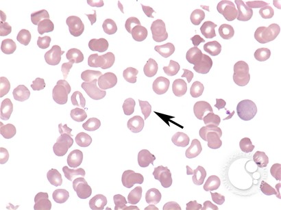 Microangiopathic hemolytic anemia - 2.
