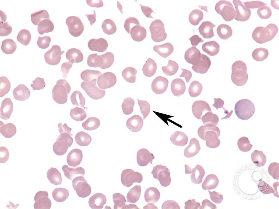 Microangiopathic hemolytic anemia - 2.