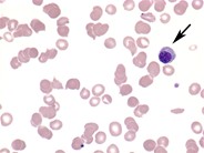 Microangiopathic hemolytic anemia - 3.