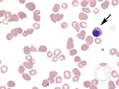 Microangiopathic hemolytic anemia - 3.