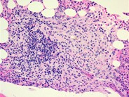 Systemic mastocytosis - 3.