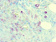 Systemic mastocytosis - 8.