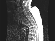 CNS AML-MRI - 1.