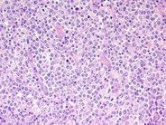 Large Diffuse B Cell Lymphoma