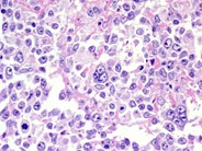 Diffuse Large B-cell Lymphoma, Anaplastic Variant - 3.