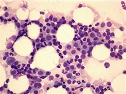 Relapsed multiple myeloma - 1.