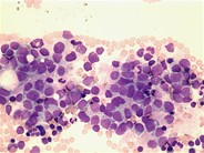 Neuroblastoma - 1.