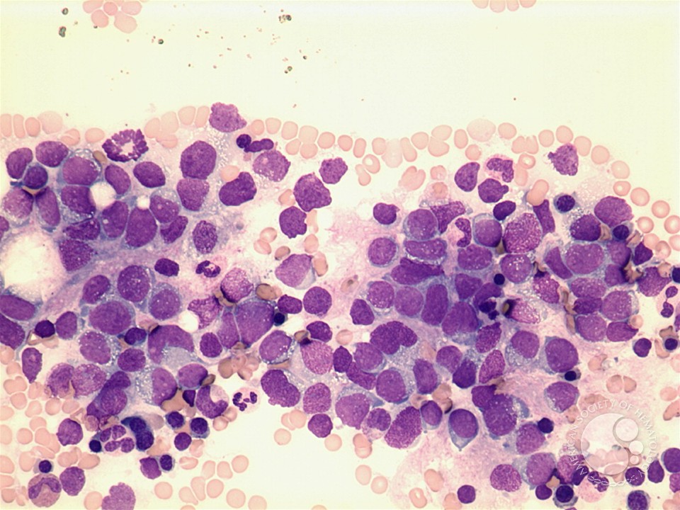 Neuroblastoma - 1.