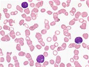 Tcell lymphoblastic leukemia 2.