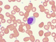 Large granular lymphocytes (LGLs) - 1.