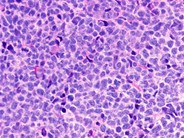 Mantle Cell Lymphoma 2