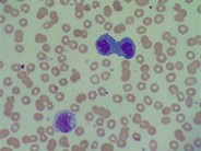 Telophase cell in peripheral smear - 1.