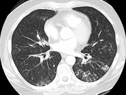 Reactive marrow: infection post-chemotherapy - 1.