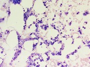 Systemic mastocystosis