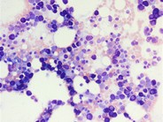 Systemic mastocystosis - 2.