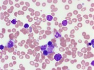 Adult T-cell leukemia/lymphoma peripheral smear - 1.