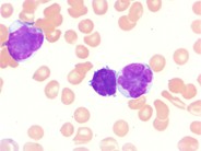 Adult T-cell leukemia/lymphoma peripheral smear - 3.