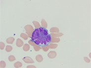 Adult T-cell leukemia/lymphoma peripheral smear - 4.