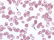 Diffusely Basophilic Erythrocyte