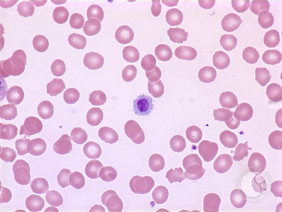 Giant platelet - 1.