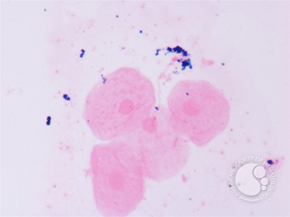 Perl’s stained-urine of an adult male who is a known case of PNH since over 10 years - 2.
