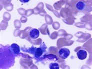 Falciparum malarial parasite in bone marrow aspirate - 1.