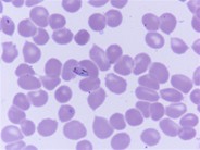 Falciparum malarial parasite in bone marrow aspirate - 2.