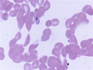 Falciparum malarial parasite in bone marrow aspirate - 3.