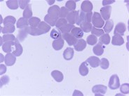 Falciparum malarial parasite in bone marrow aspirate - 5.