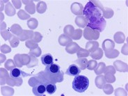 Falciparum malarial parasite in bone marrow aspirate - 8.