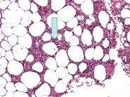 Adrenal myelolipoma - 1.