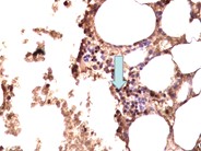 Adrenal myelolipoma - 2.