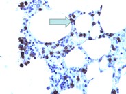 Adrenal myelolipoma - 3.